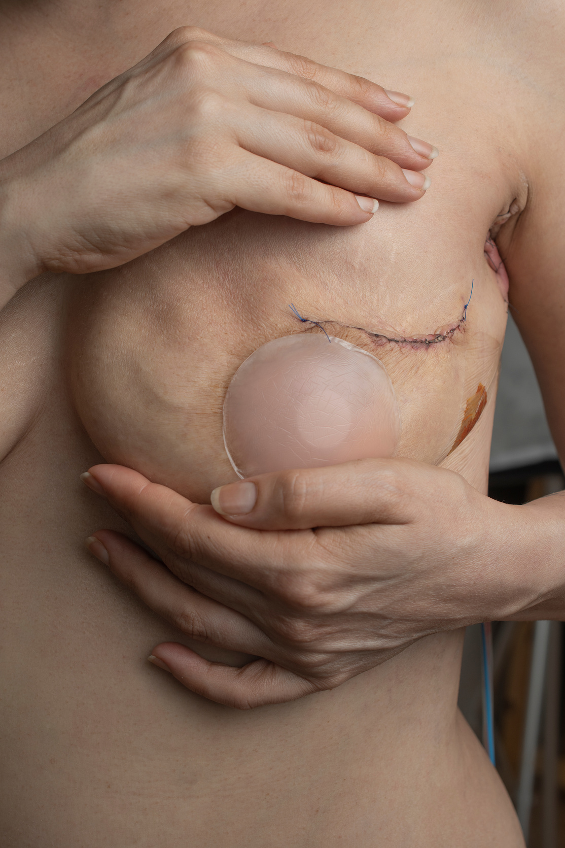 Scars from Mastectomy Surgery Due to Breast Cancer